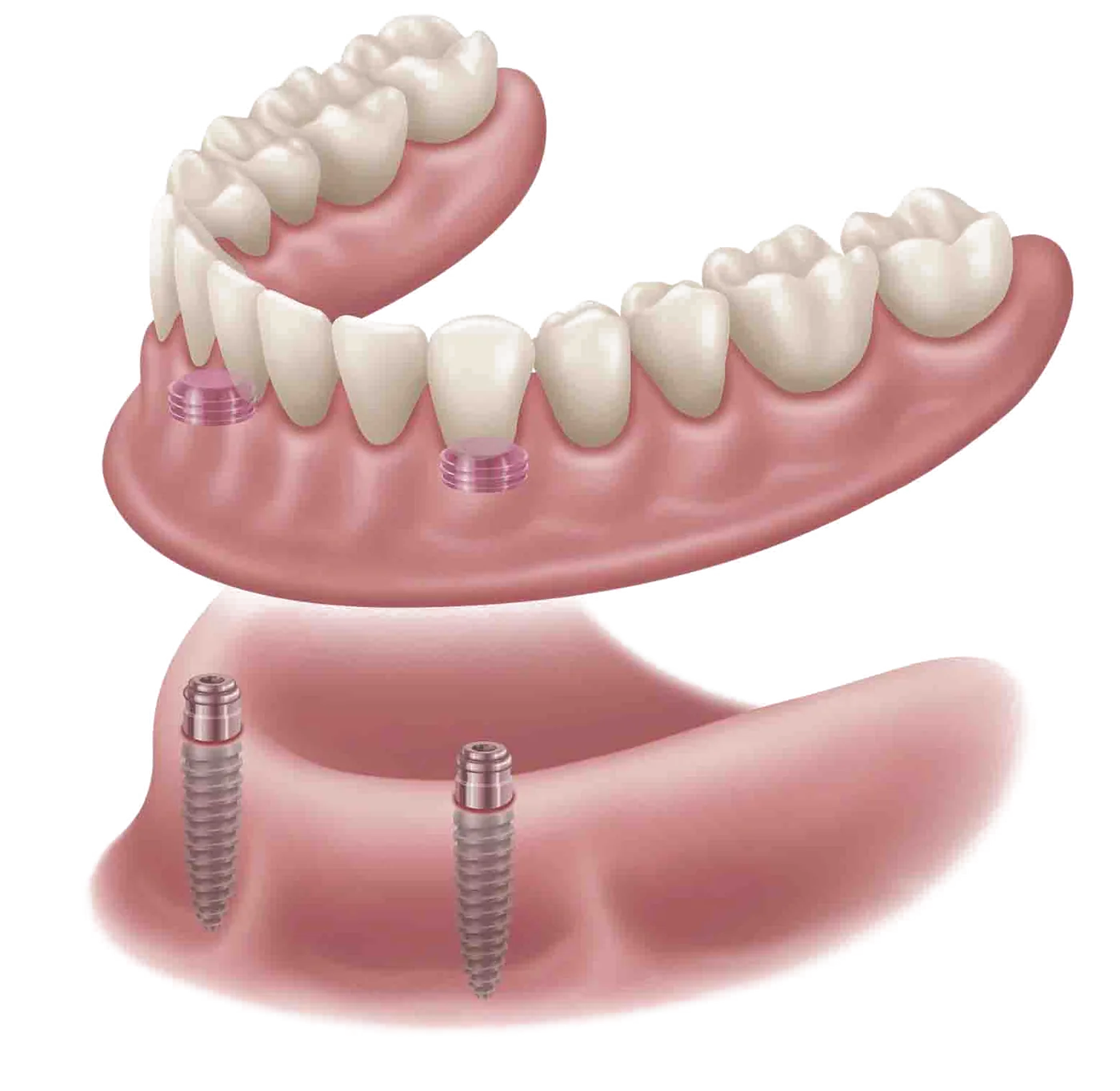 Diagram of a lower denture attached to two dental implants